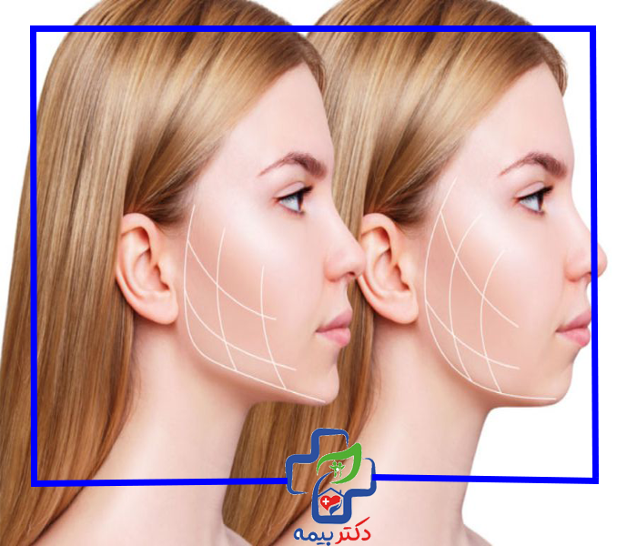 آیا جراحی فک شامل بیمه تکمیلی می شود؟ 